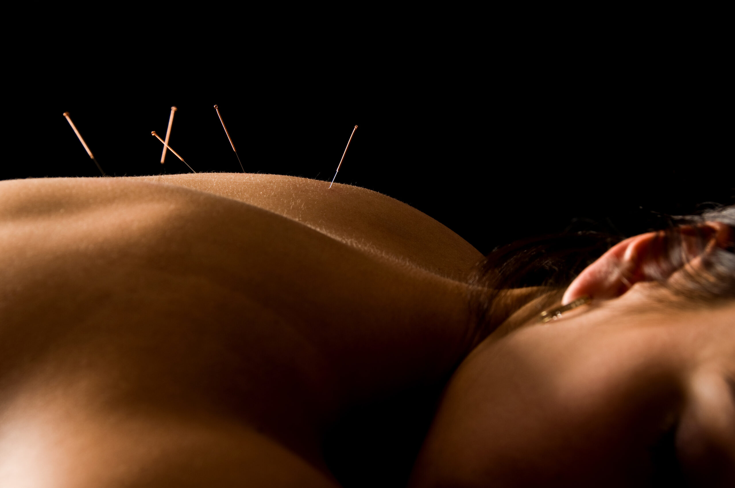 Thrive spine and sports rehab acupuncture